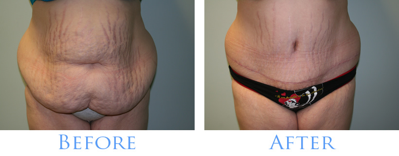 Before and After Tummy Tuck Images