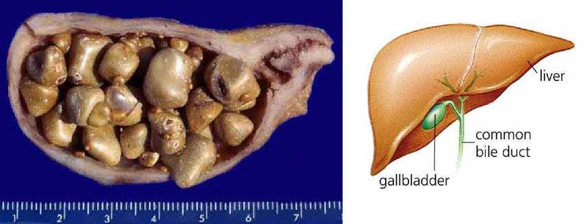 Gallstones and Gallbladder Anatomy