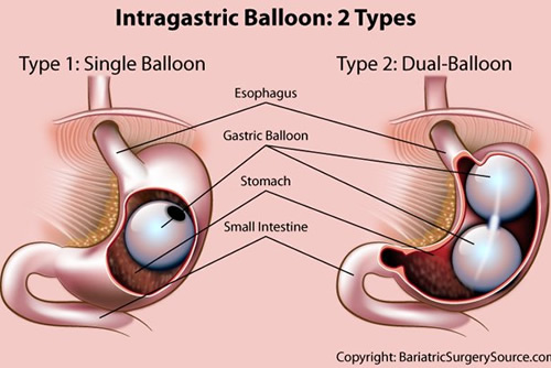 Gastric Balloon