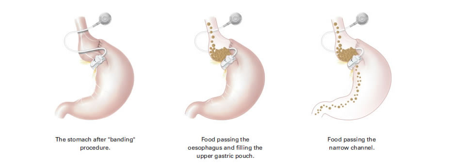 How does the gastric band work?
