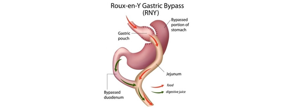 Gastric Bypass Surgery