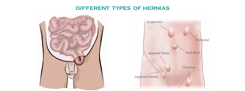 Different types of hernias