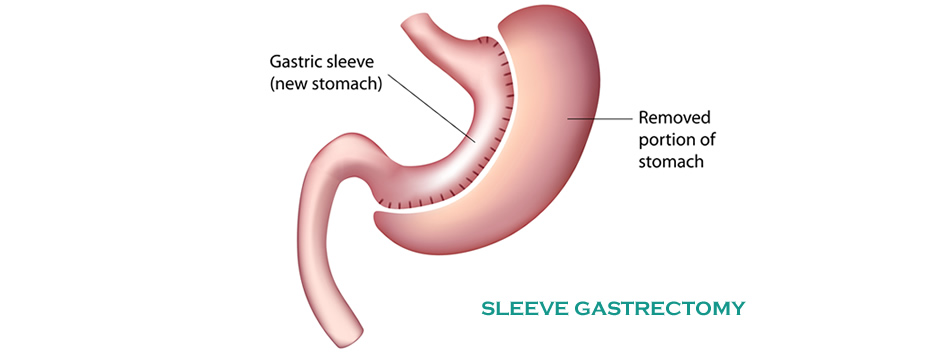 Sleeve Gastrectomy