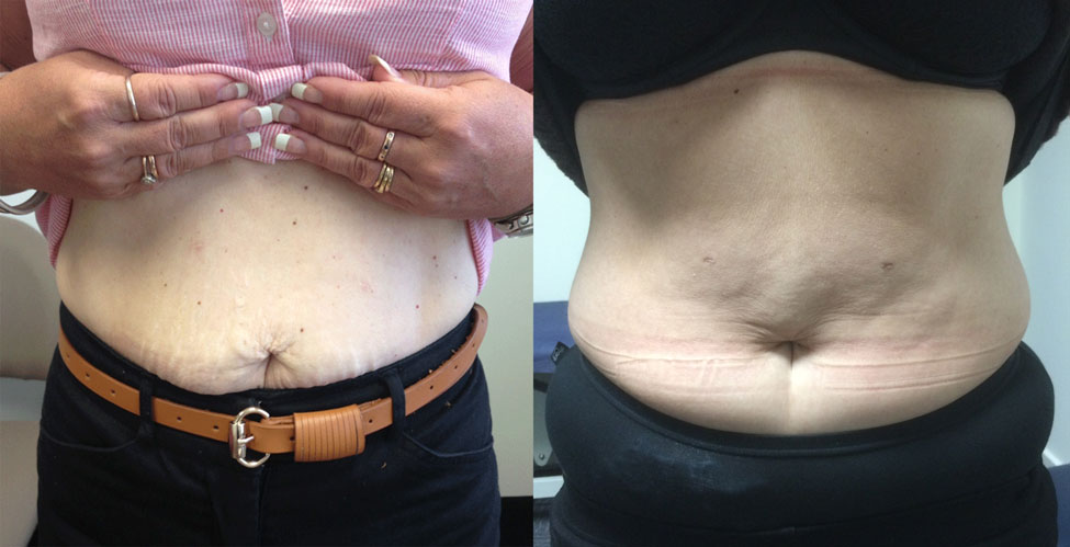 Scars from Minimally Invasive Sleeve Gastrectomy