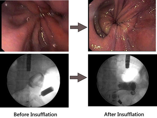 Endoscopic and Radiological images of unstable gastric band