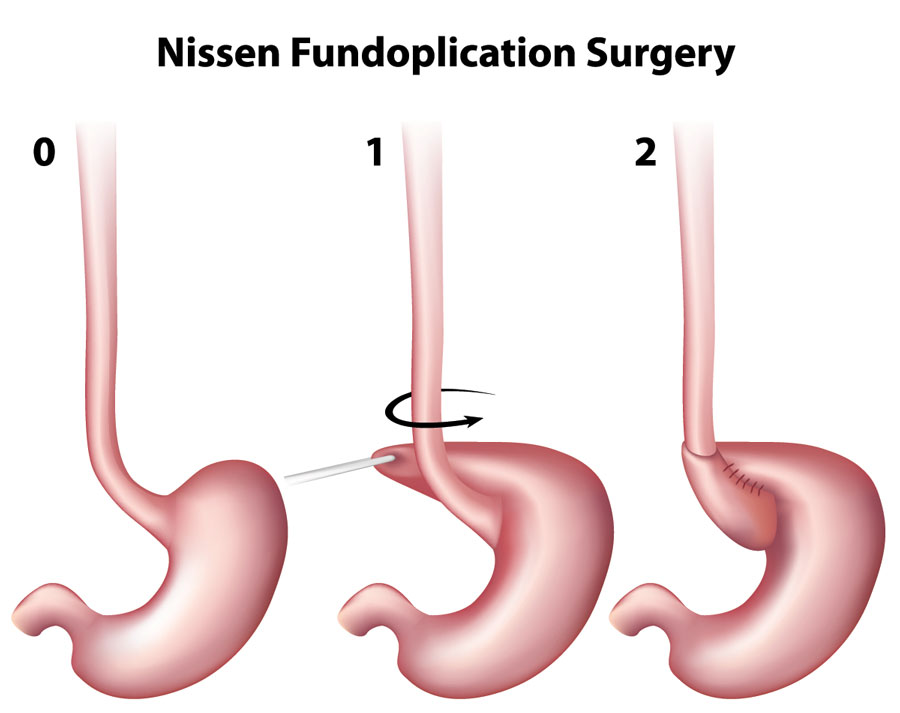 Surgical fundoplication diagram for reflux
