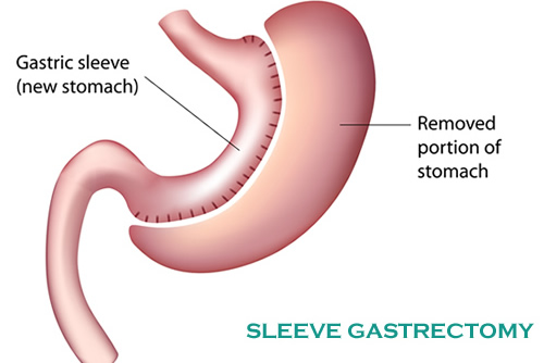 Sleeve gastrectomy