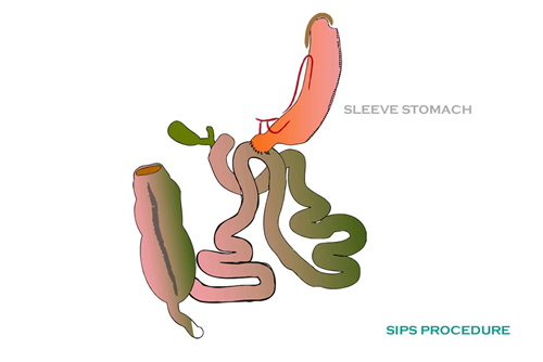 Update on SIPS or SADI procedure (loop duodenal switch)